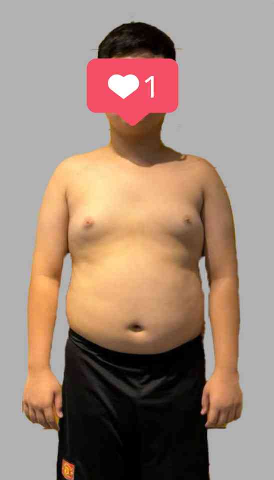 Bé trai béo phì với bụng to trước khi tham gia chương trình tập luyện tại Live Fit Kid